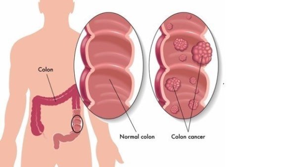 Does cutting polyps hurt? Do you have to cut it? Health Tester: 4 things you want to know about painless stomach lens